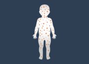 Vaksinasi Dan Isolasi: Strategi RSU Haji Medan Redam Penyebaran Campak