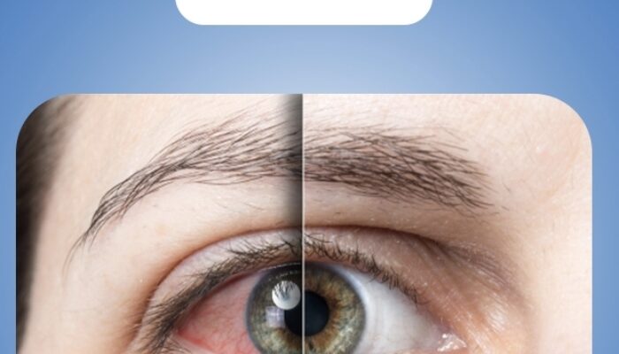 Mengenal SiLK, Teknologi LASIK Tanpa Flap yang Lebih Nyaman dan Minim Risiko