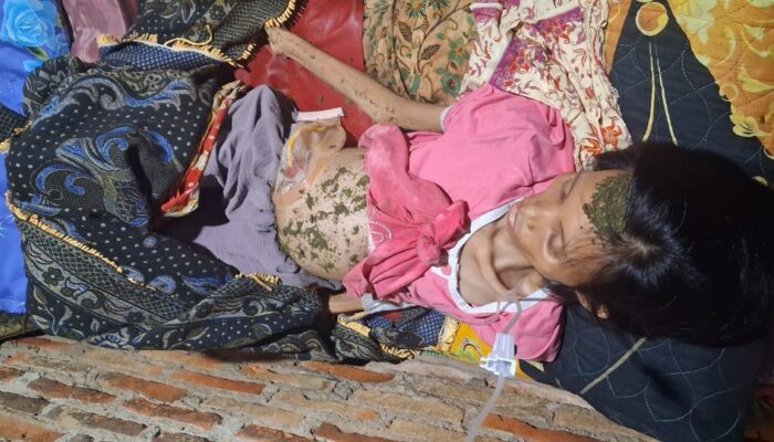 Tumor Halang Wisuda, Mahasiswa Ini Berjuang Cari Biaya Pengobatan