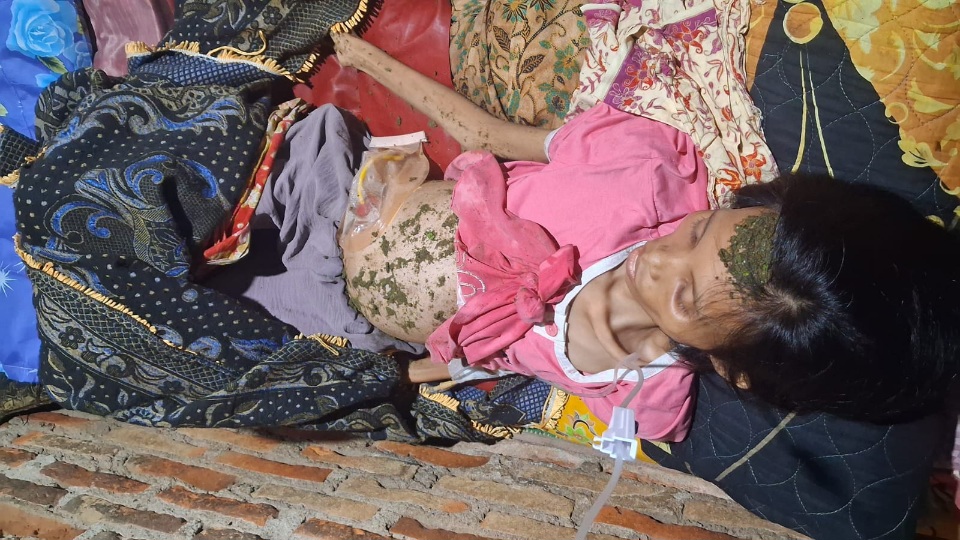 Tumor Halang Wisuda, Mahasiswa Ini Berjuang Cari Biaya Pengobatan