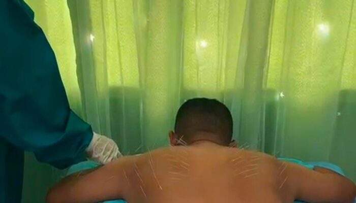 Puskesmas Langsa Barat Buka Layanan Klinik Therapy Akupuntur
