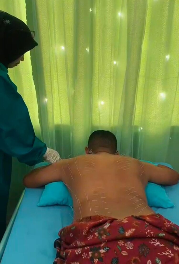 Puskesmas Langsa Barat Buka Layanan Klinik Therapy Akupuntur